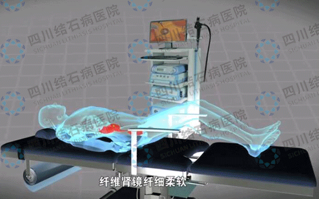 玩花样的石头——肾结石(图4)