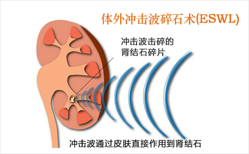 肾结石的治疗方法大全都在这里！(图8)