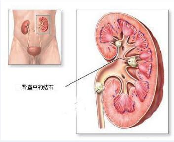 关于肾结石治疗，你该知道的4件事！(图2)