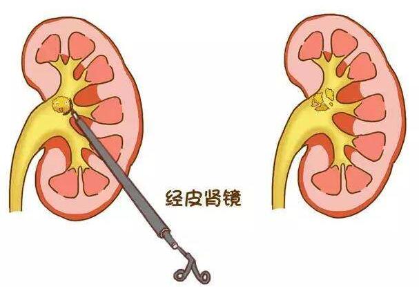 患者疑问：肾结石怎么治疗好？(图2)
