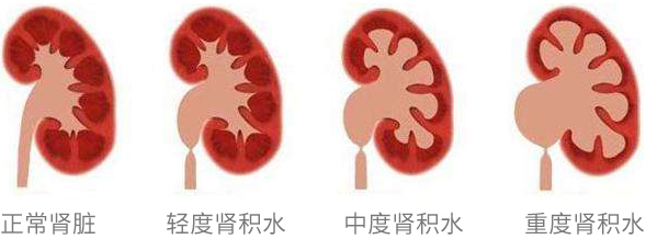 四川治疗肾积水哪家医院好?(图1)