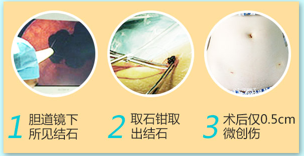 胆结石的治疗方法有哪些?该如何治疗好(图7)