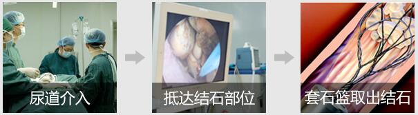 从保守治疗到微创取石 一站式解决各类肾结石(图3)
