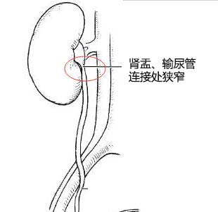 肾积水是怎么回事，什么原因引起的?(图2)