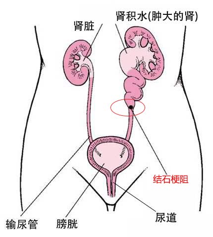 肾结石严重吗？要不要紧？(图7)