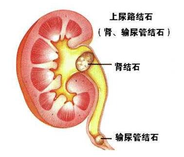 肾积水是怎么回事，什么原因引起的?(图4)