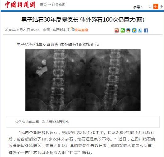 男子结石30年反复疯长 体外碎石100次仍巨大(图5)