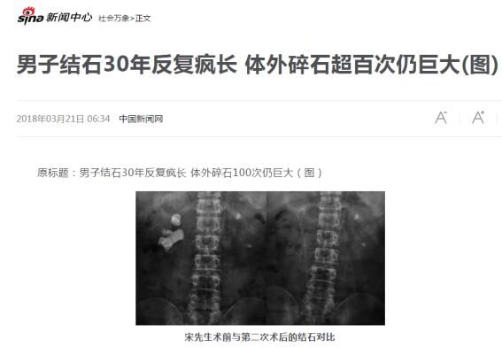 男子结石30年反复疯长 体外碎石100次仍巨大(图6)