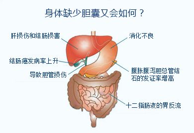 母子同患胆囊结石 相隔十年结局大不同(图6)