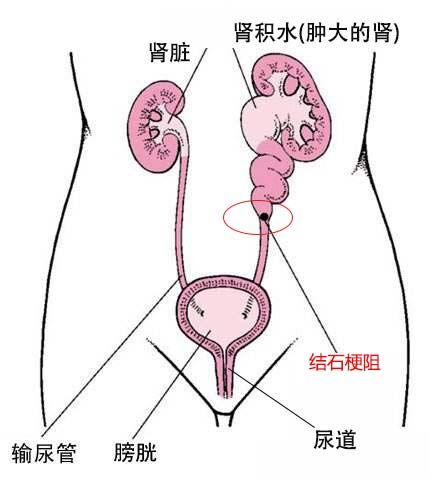 引起肾结石的4大因素，看看你是如何中招的(图3)