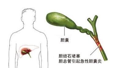 多大的胆结石需要治疗？一定要切胆吗？(图8)