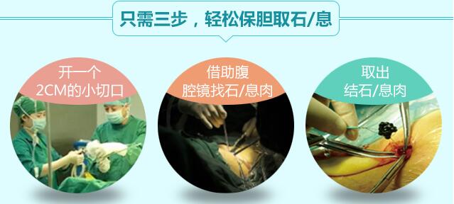 胆结石只能切胆吗？(图5)