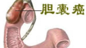 胆囊息肉危害听我说！(图1)