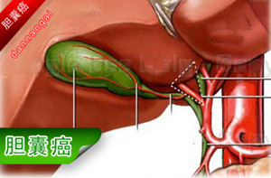 充满性胆结石(图1)