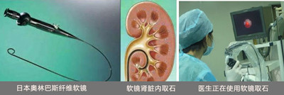 得了肾结石怎么办?(图3) 得了肾结石怎么办?(图3)