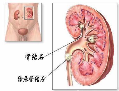 怎么治疗肾结石(图1)