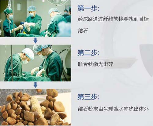 结石病应该怎么治疗？(图9)