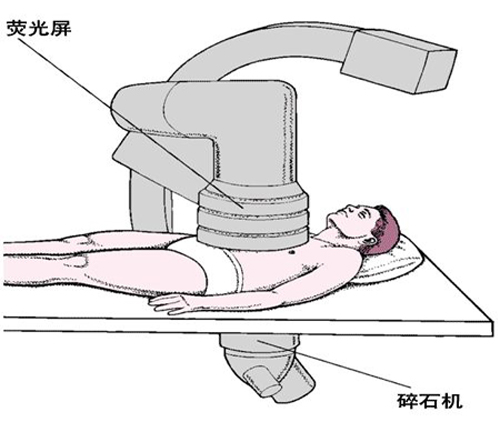 结石多大需要碎石(图2)
