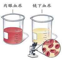 肾结石得症状有哪些(图2)