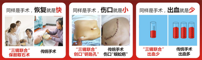 惊喜！治疗胆结石不再只是切胆！(图1)