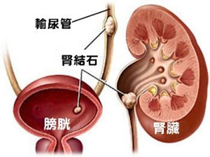 肾结石影响性生活吗(图1)