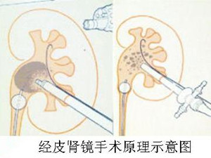 肾结石会在哪个部位造成疼痛？(图3)