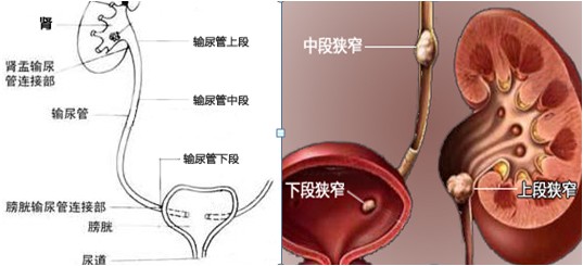 你适合做体外碎石吗？(图4)