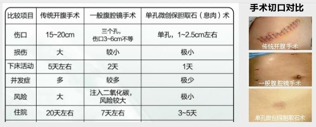 胆结石多大需要做手术呢？(图6)
