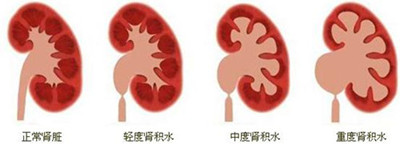 肾结石的临床表现有哪些(图1)