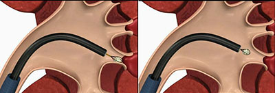 解析肾结石(图5)