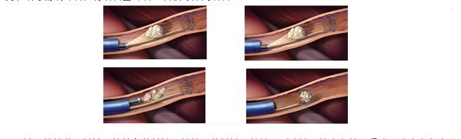 专家解析：输尿管结石疗法(图3)