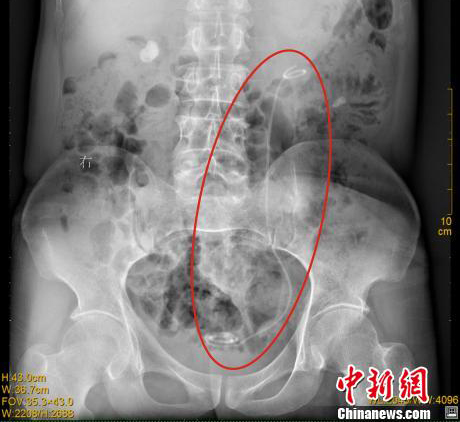 吓人！我院专家从一男子体内取出30厘米导管(图1)