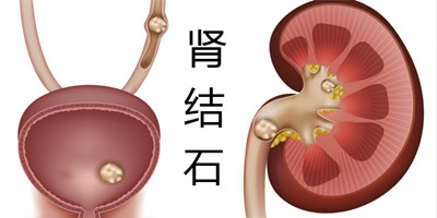 肾结石怎么排出？选对方法是关键(图1)