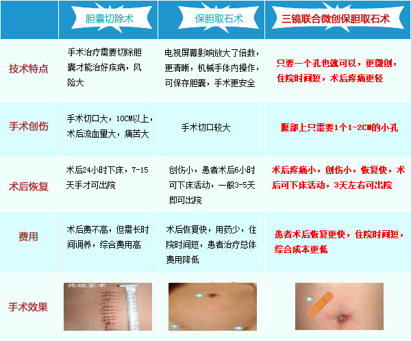 治疗胆结石好的方法——微创保胆取石术(图8)