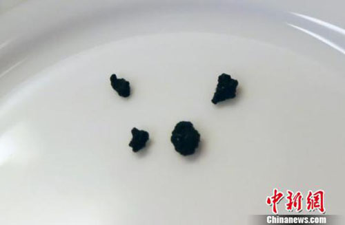 把辣条当早餐 9岁男童患上胆囊结石(图1)