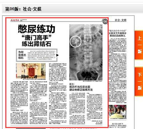 每天憋尿练功 四川“唐门高手”练出肾结石(图3)