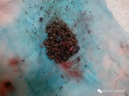 每天憋尿练功 四川“唐门高手”练出肾结石(图6)