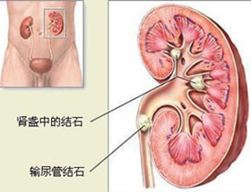 肾结石的危害有哪些？(图2)