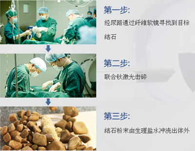 得了肾结石不手术可以治疗好吗?(图2)