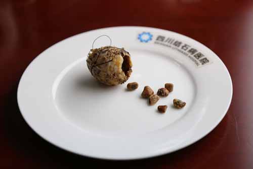 成都85岁老人胆囊变“陶瓷” 内藏7颗结石(图1)