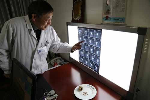 成都85岁老人胆囊变“陶瓷” 内藏7颗结石(图2)