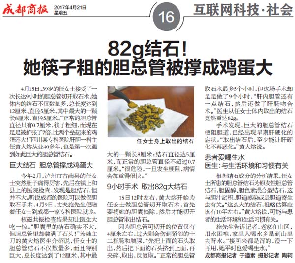 【成都商报】82g结石！ 她筷子粗的胆总管被撑成鸡蛋大(图1)