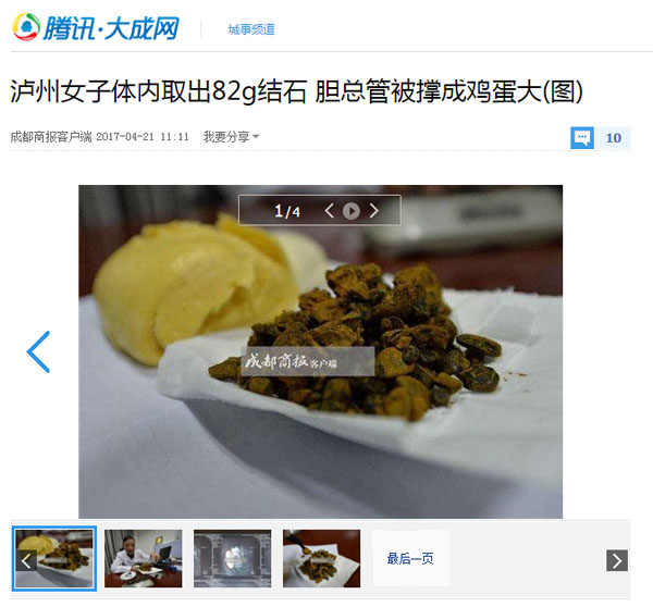 【成都商报】82g结石！ 她筷子粗的胆总管被撑成鸡蛋大(图2)