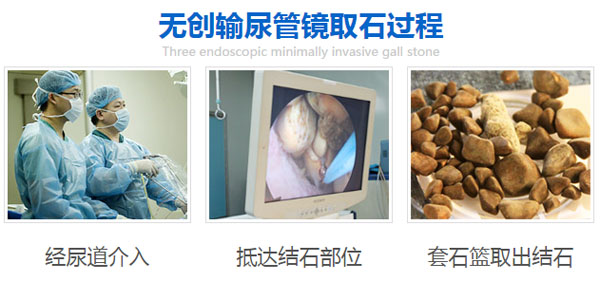 【成都日报】患海绵肾！68岁老人被结石反复折磨(图2)