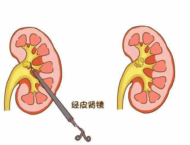 大小不同的肾结石分别怎么治？(图2)