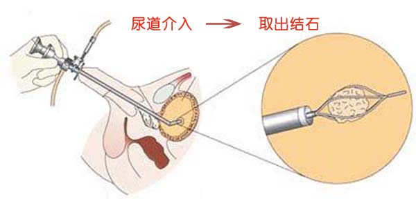 【成都日报】2名飞行学员紧急求助：快帮我取出肾结石 圆我飞行梦(图2)