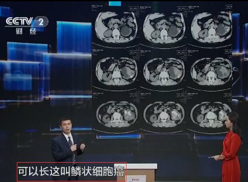 根据这些症状自测是否患肾结石(图1)