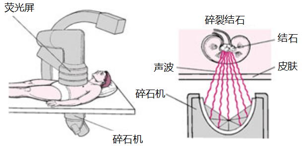 输尿管结石的两种疗法，总有一种适合你(图2)