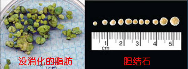 化结石，你吃对东西了吗？(图3)