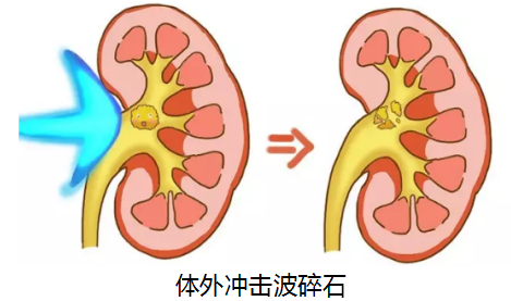 尿结石做碎石，找对医院，只用花这些钱(图1)